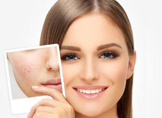 خلطات تخلّصك من البثور نهائيًّا… جرّبيها وستذهلك النتيجة!