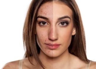 طرق طبيعية لإزالة حفر الوجه