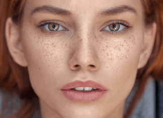 خلطة طبيعية للتخلص من النمش والكلف