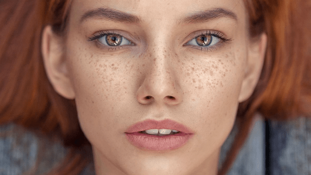 header_image_fustany-beauty-skincare-the_beauty_of_freckles-main_image1